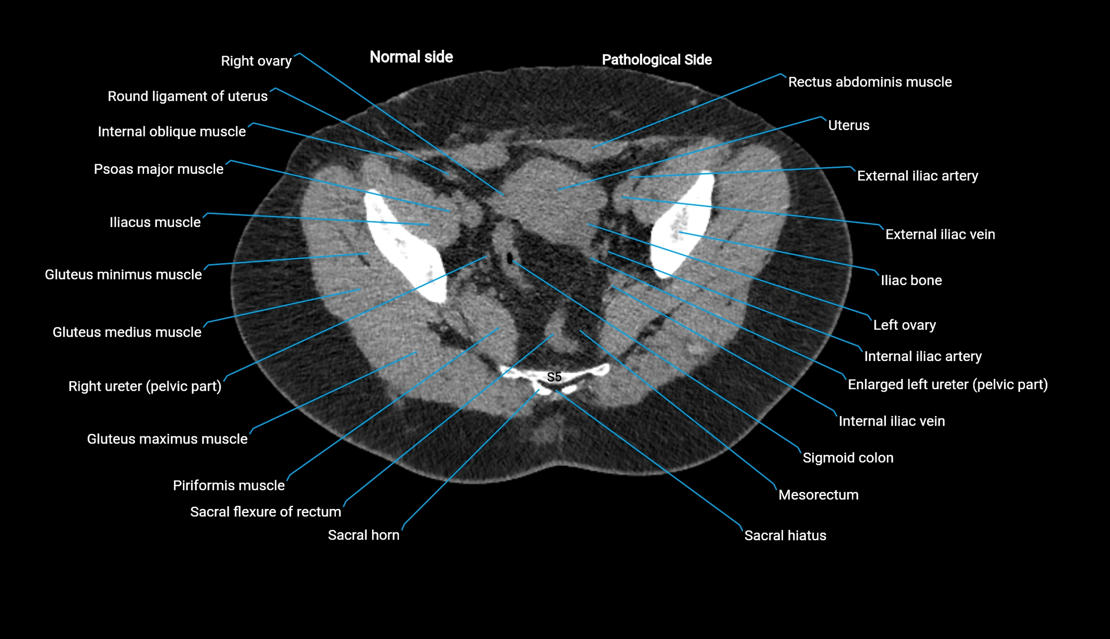 CT KUB axial cross sectional anatomy  radiology image -img-00201-00139.webp